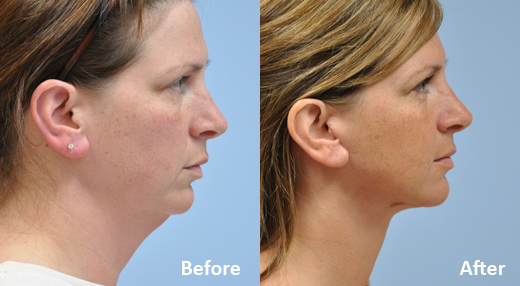 Neck Lift before and after photo by Midwest Facial Plastic Surgery in Minnesota Neck Lift before and after photo by Midwest Facial Plastic Surgery in Minnesota