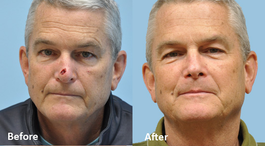 Mohs Reconstruction before and after photo by Midwest Facial Plastic Surgery in Minnesota