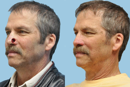 Mohs Reconstruction before and after photo by Midwest Facial Plastic Surgery in Minnesota