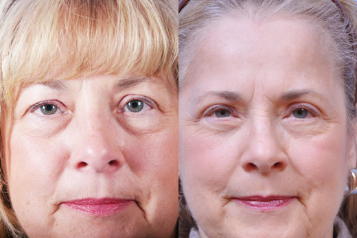 Eyelid Surgery before and after photo by Midwest Facial Plastic Surgery in Minnesota