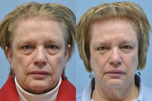 Eyelid Surgery before and after photo by Midwest Facial Plastic Surgery in Minnesota