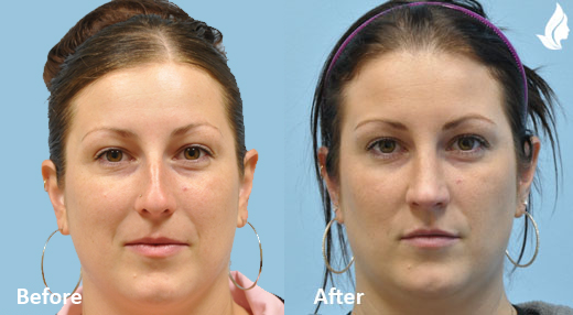 Rhinoplasty before and after photo by Midwest Facial Plastic Surgery in Minnesota