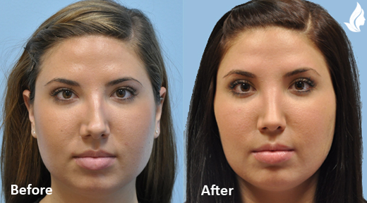 Rhinoplasty before and after photo by Midwest Facial Plastic Surgery in Minnesota