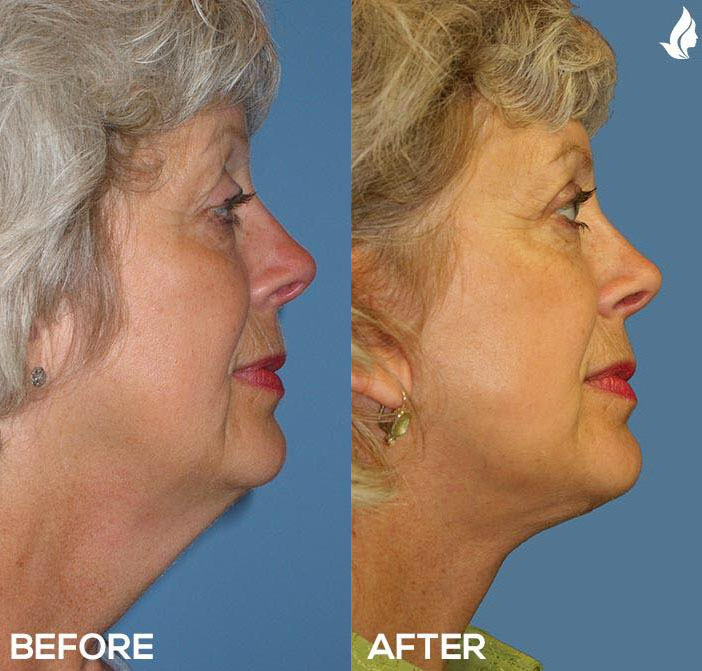 Neck Lift before and after photo by Midwest Facial Plastic Surgery in Minnesota