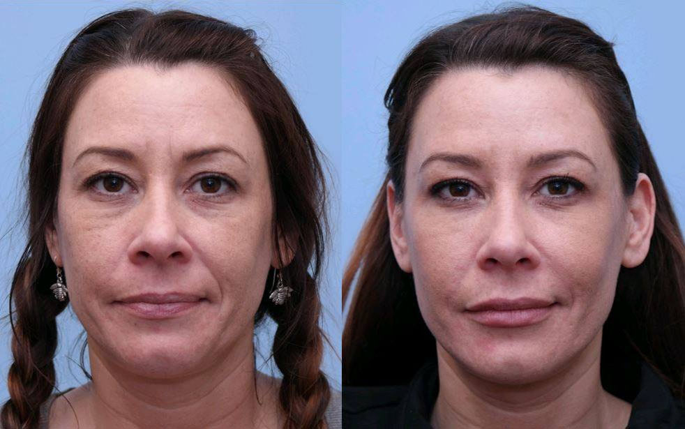 Injectable Fillers before and after photo by Midwest Facial Plastic Surgery in Minnesota