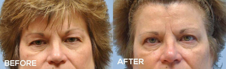 Eyelid Surgery before and after photo by Midwest Facial Plastic Surgery in Minnesota