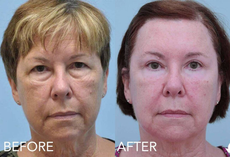 Eyelid Surgery before and after photo by Midwest Facial Plastic Surgery in Minnesota