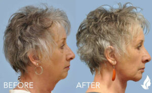 Injectable Fillers before and after photo by Midwest Facial Plastic Surgery in Minnesota