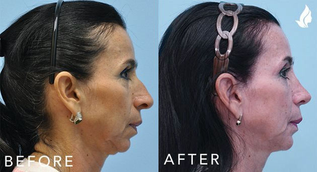 Facial Implants Chin Augmentation before and after photo by Midwest Facial Plastic Surgery in Minnesota