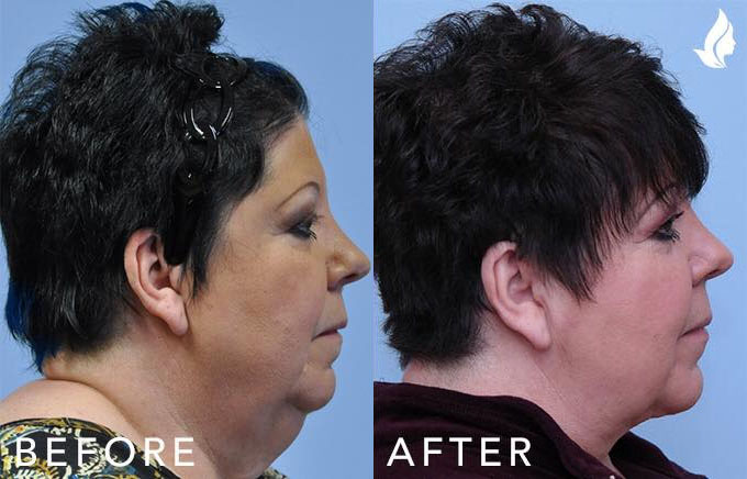 Neck Lift before and after photo by Midwest Facial Plastic Surgery in Minnesota