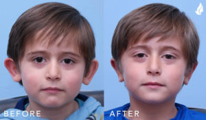 Otoplasty (Ear Reconstruction) before and after photo by Midwest Facial Plastic Surgery in Minnesota