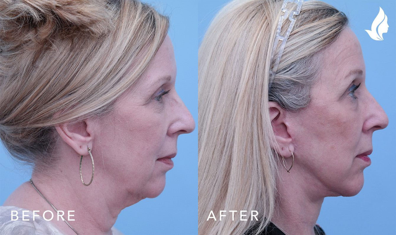 Facelift before and after photo by Midwest Facial Plastic Surgery in Minnesota