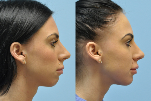 Injectable Fillers before and after photo by Midwest Facial Plastic Surgery in Minnesota