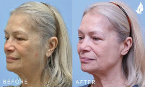 Otoplasty (Ear Reconstruction) before and after photo by Midwest Facial Plastic Surgery in Minnesota