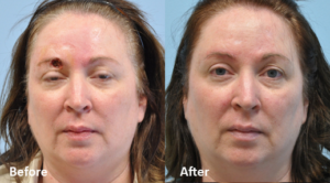Mohs Reconstruction before and after photo by Midwest Facial Plastic Surgery in Minnesota