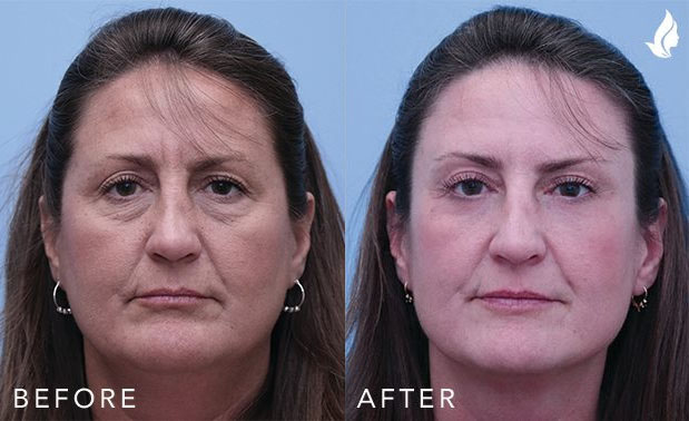 Eyelid Surgery before and after photo by Midwest Facial Plastic Surgery in Minnesota