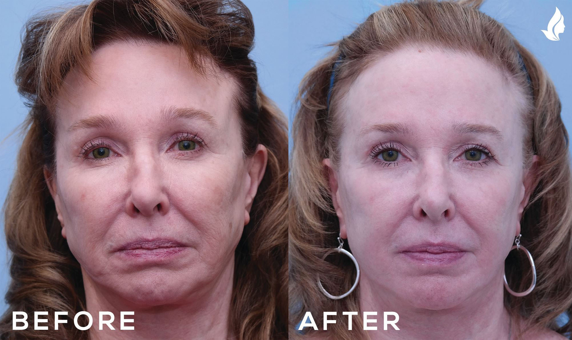 Laser Skin Resurfacing before and after photo by Midwest Facial Plastic Surgery in Minnesota