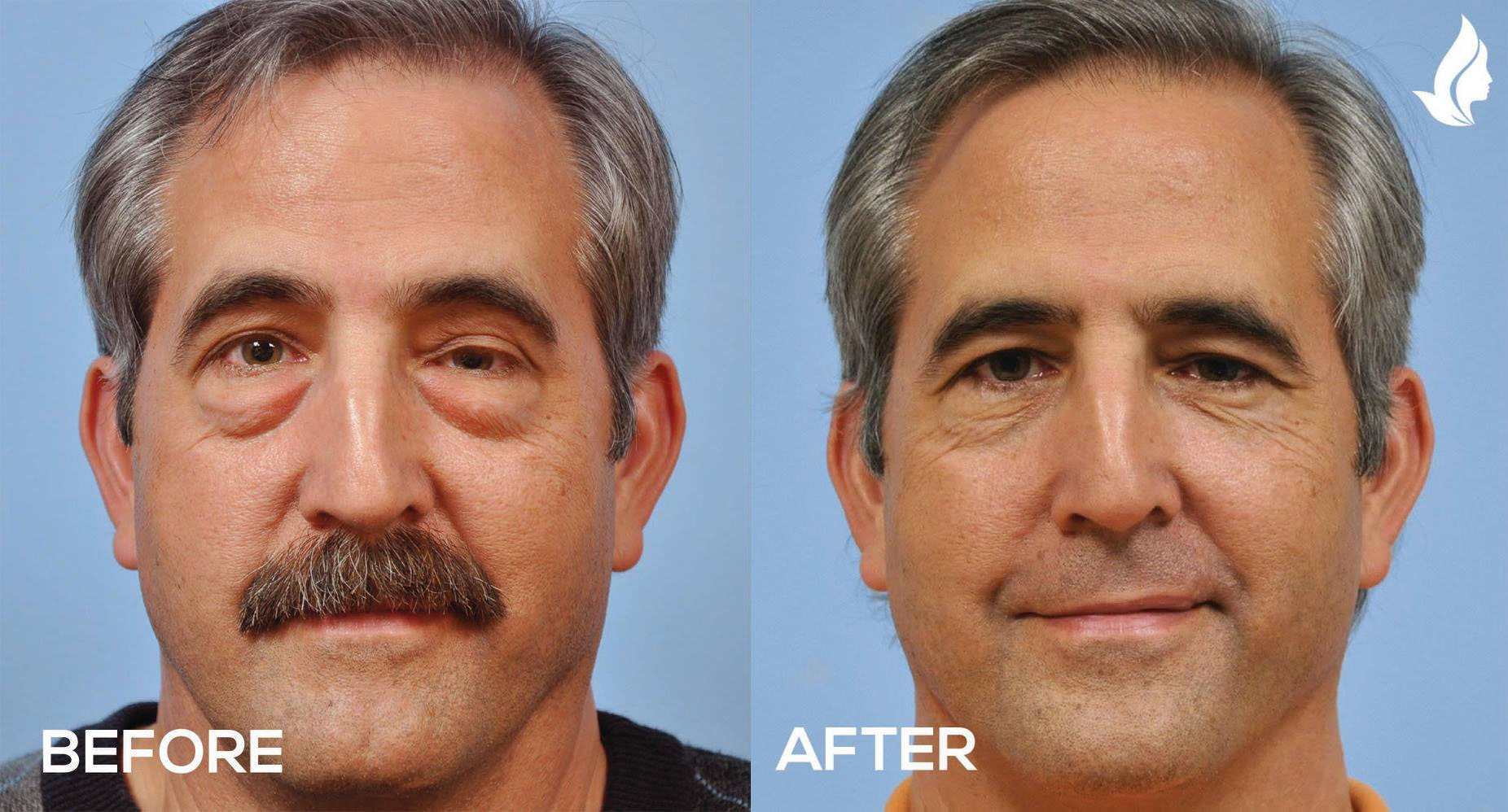 Eyelid Surgery before and after photo by Midwest Facial Plastic Surgery in Minnesota