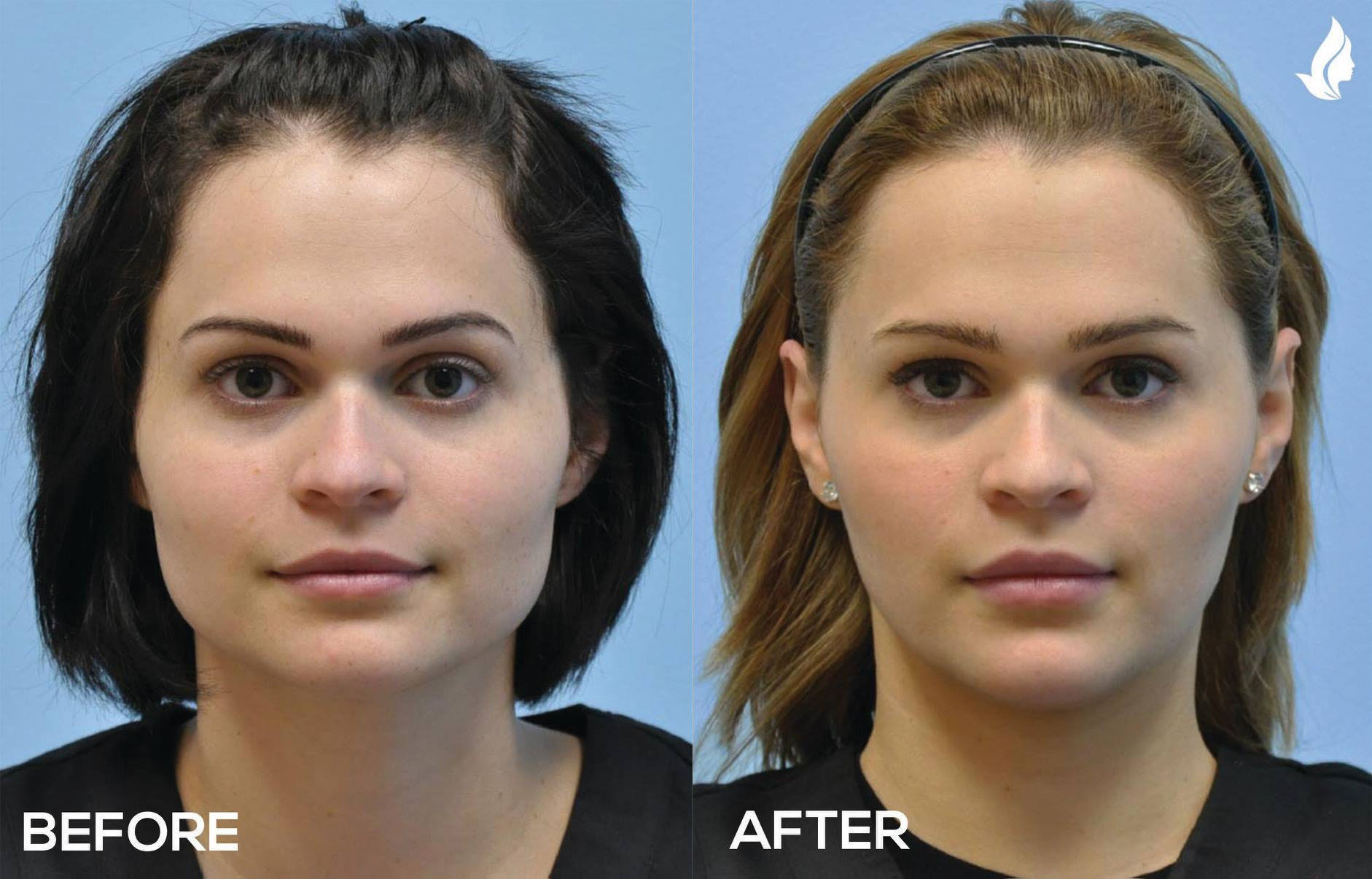 Injectable Fillers before and after photo by Midwest Facial Plastic Surgery in Minnesota