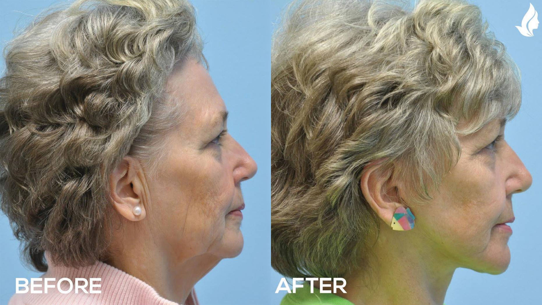 Facelift before and after photo by Midwest Facial Plastic Surgery in Minnesota