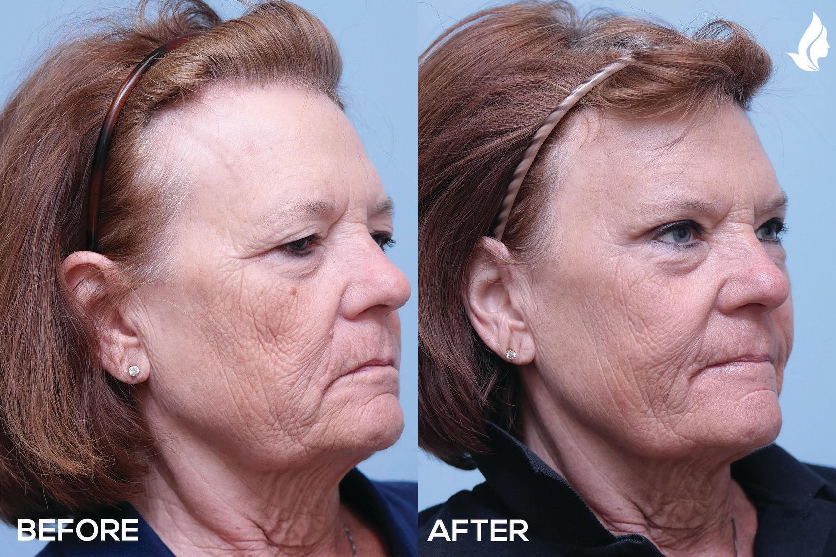 Eyelid Surgery before and after photo by Midwest Facial Plastic Surgery in Minnesota