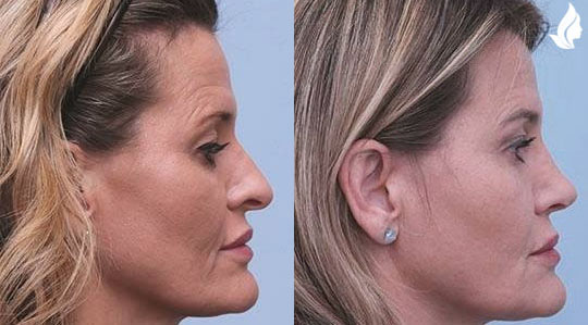 Rhinoplasty before and after photo by Midwest Facial Plastic Surgery in Minnesota