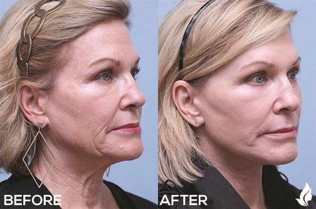 Eyelid Surgery before and after photo by Midwest Facial Plastic Surgery in Minnesota