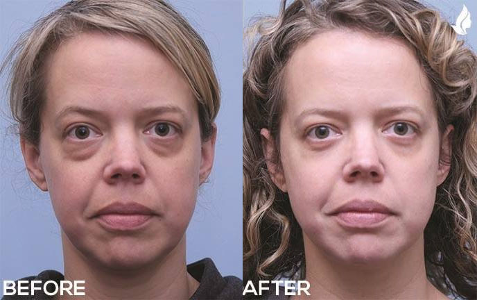 Eyelid Surgery before and after photo by Midwest Facial Plastic Surgery in Minnesota