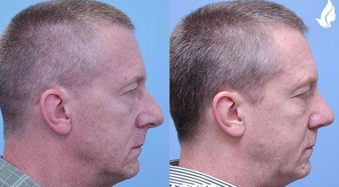 Rhinoplasty before and after photo by Midwest Facial Plastic Surgery in Minnesota