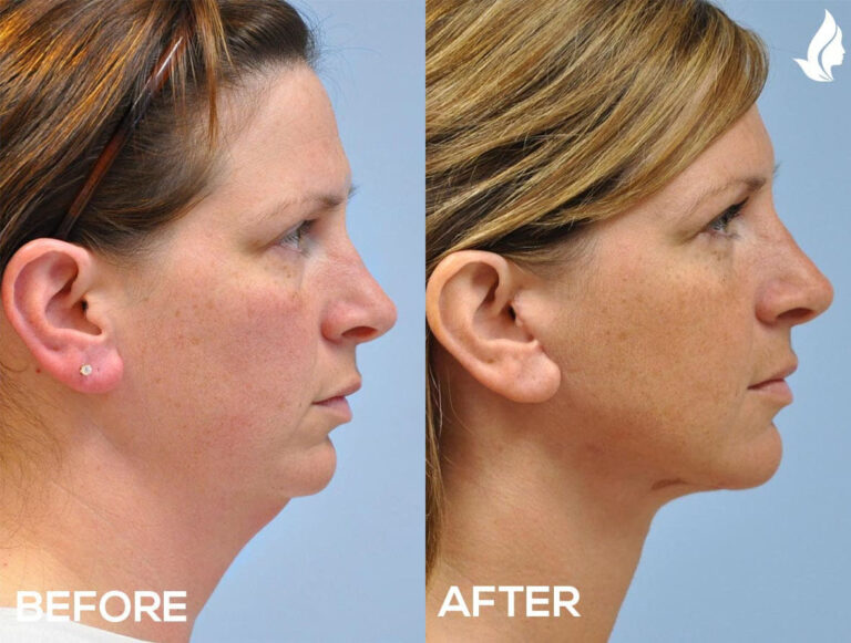 Neck Lift before and after photo by Midwest Facial Plastic Surgery in Minnesota