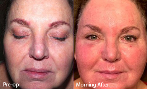 Laser Skin Resurfacing before and after photo by Midwest Facial Plastic Surgery in Minnesota