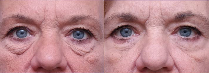 Eyelid Surgery before and after photo by Midwest Facial Plastic Surgery in Minnesota
