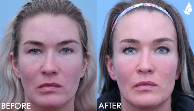 Bells Palsy before and after photo by Midwest Facial Plastic Surgery in Minnesota