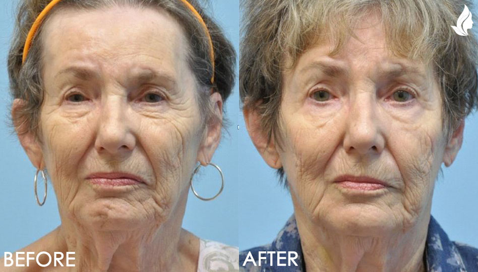Bells Palsy before and after photo by Midwest Facial Plastic Surgery in Minnesota Bells Palsy before and after photo by Midwest Facial Plastic Surgery in Minnesota