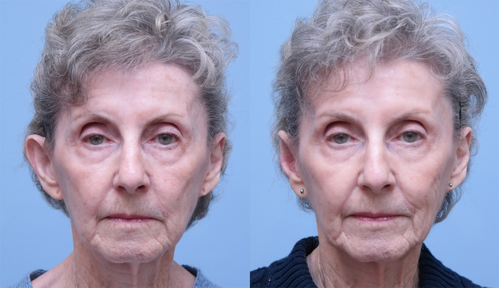 Otoplasty (Ear Reconstruction) before and after photo by Midwest Facial Plastic Surgery in Minnesota