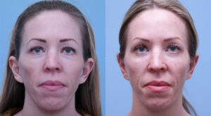 Otoplasty (Ear Reconstruction) before and after photo by Midwest Facial Plastic Surgery in Minnesota