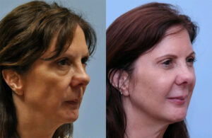Injectable Fillers before and after photo by Midwest Facial Plastic Surgery in Minnesota