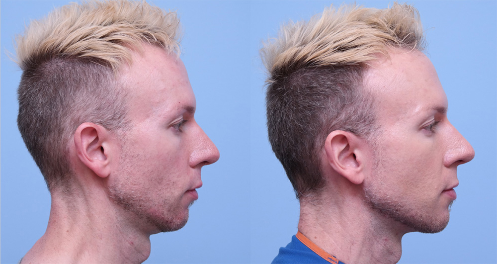 Injectable Fillers before and after photo by Midwest Facial Plastic Surgery in Minnesota