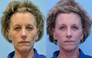 Injectable Fillers before and after photo by Midwest Facial Plastic Surgery in Minnesota