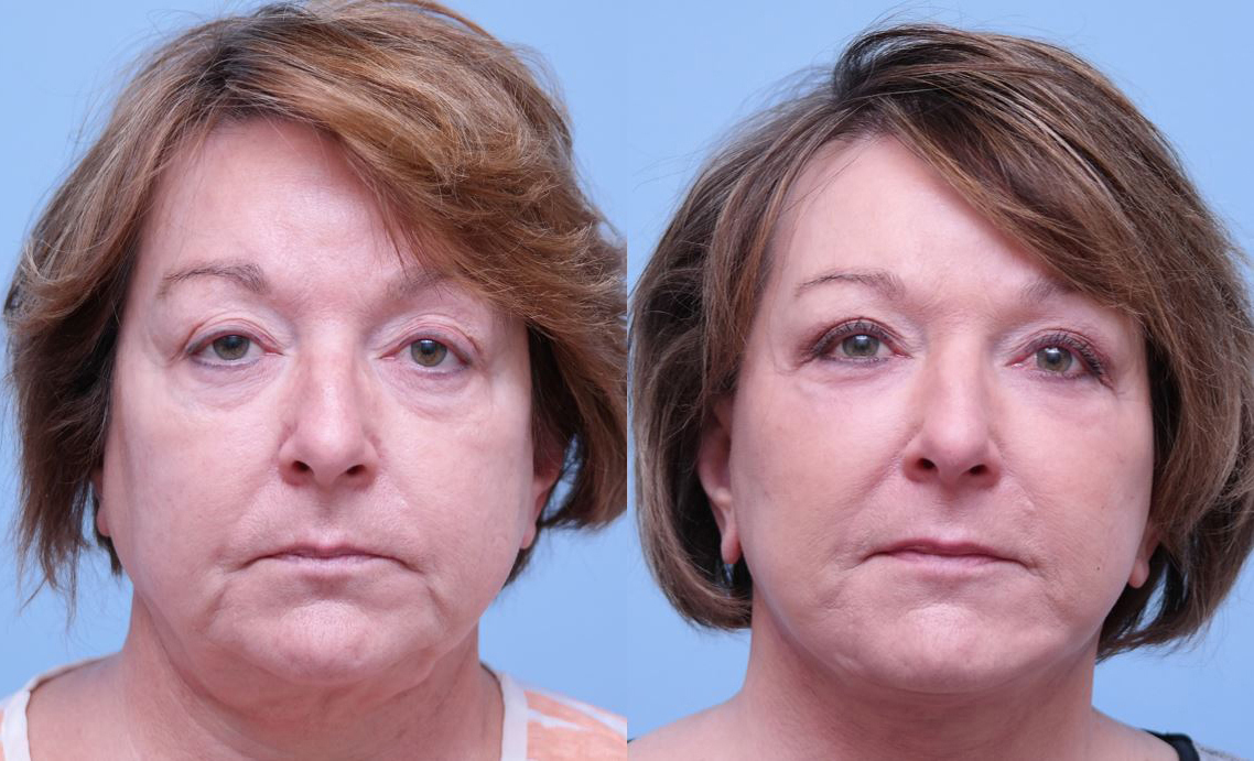 Facelift before and after photo by Midwest Facial Plastic Surgery in Minnesota