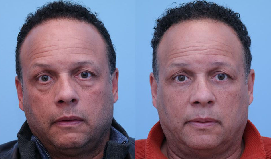 Eyelid Surgery before and after photo by Midwest Facial Plastic Surgery in Minnesota