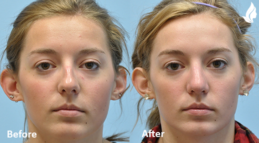 Rhinoplasty before and after photo by Midwest Facial Plastic Surgery in Minnesota