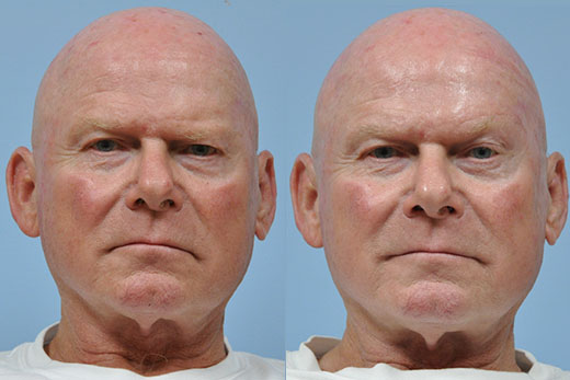 Facial Paralysis before and after photo by Midwest Facial Plastic Surgery in Minnesota