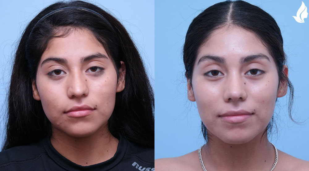 Rhinoplasty before and after photo by Midwest Facial Plastic Surgery in Minnesota