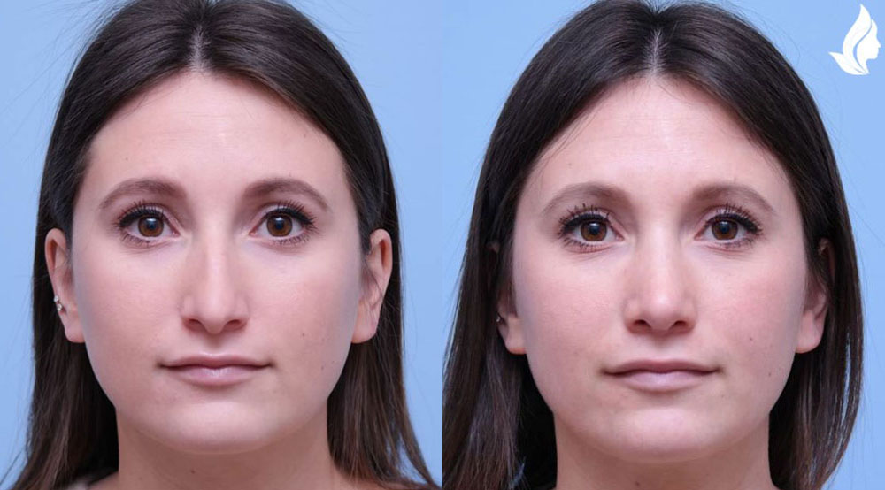 Rhinoplasty before and after photo by Midwest Facial Plastic Surgery in Minnesota Rhinoplasty before and after photo by Midwest Facial Plastic Surgery in Minnesota