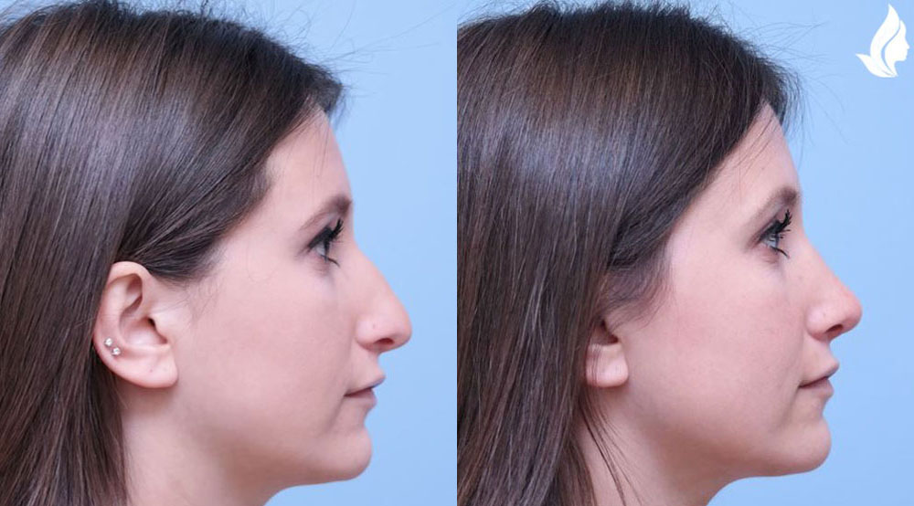 Rhinoplasty before and after photo by Midwest Facial Plastic Surgery in Minnesota Rhinoplasty before and after photo by Midwest Facial Plastic Surgery in Minnesota