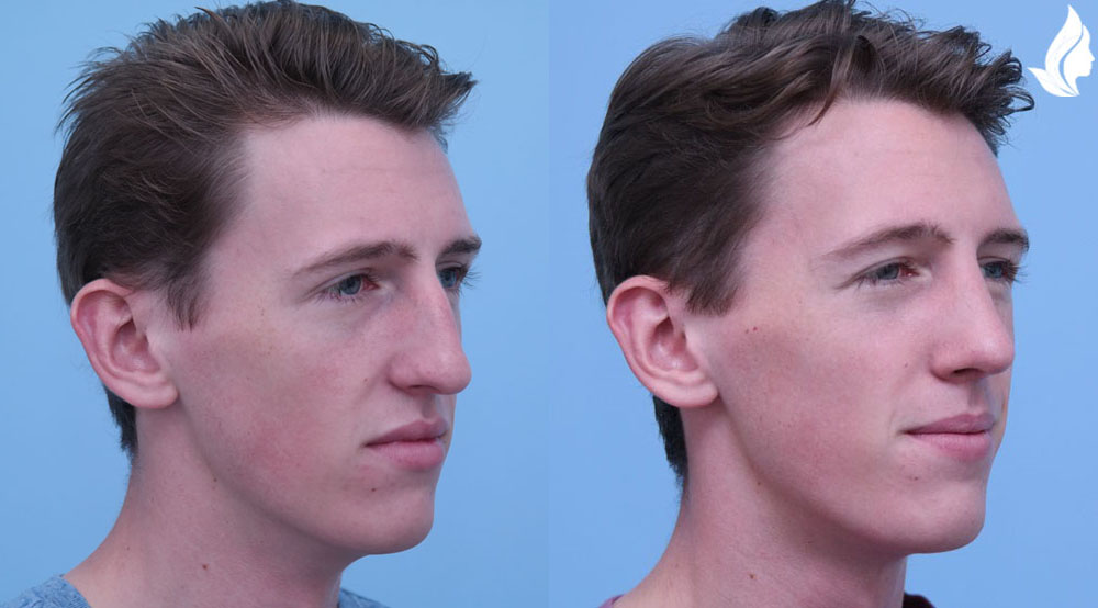 Rhinoplasty before and after photo by Midwest Facial Plastic Surgery in Minnesota