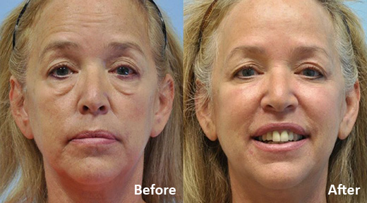 Eyelid Surgery before and after photo by Midwest Facial Plastic Surgery in Minnesota