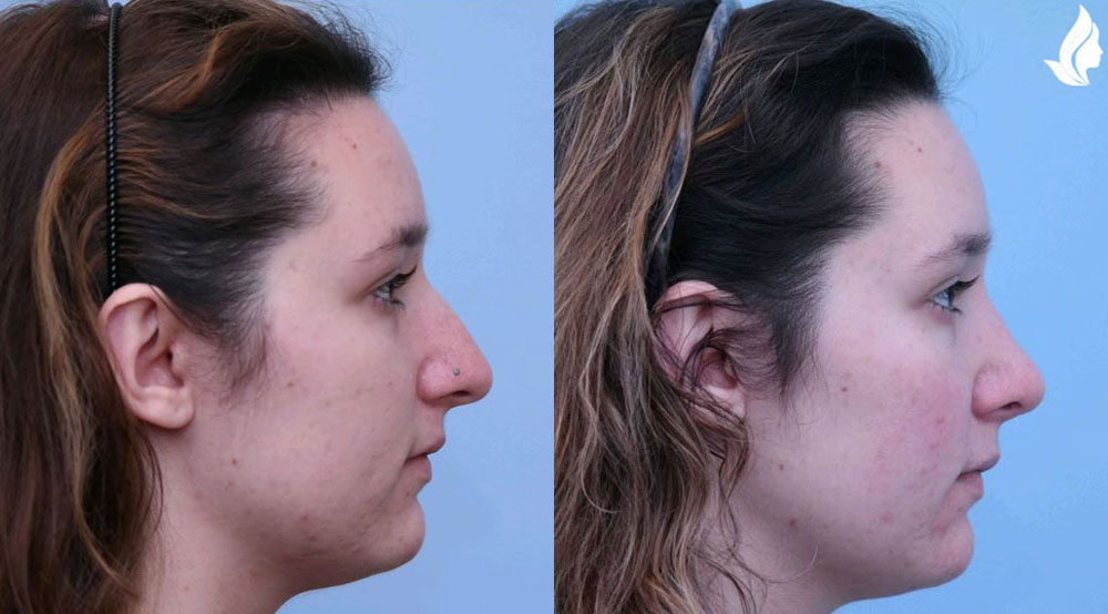 Rhinoplasty before and after photo by Midwest Facial Plastic Surgery in Minnesota