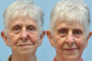 Mohs Reconstruction before and after photo by Midwest Facial Plastic Surgery in Minnesota